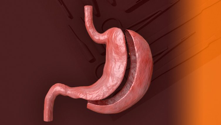 Gastrectomia total e parcial - Imagem Ilustativa